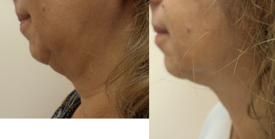 Kybella before and after photo