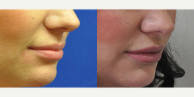 Lip Fillers before and after photo