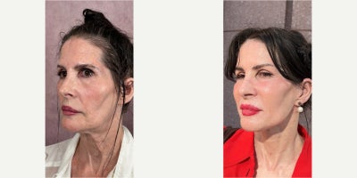 before and after image