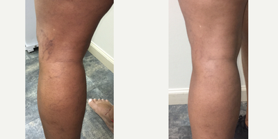 Sclerotherapy before and after photo