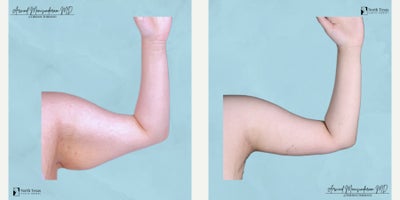 Arm Lift before and after photo