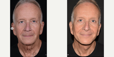 Eyelid Surgery before and after photo