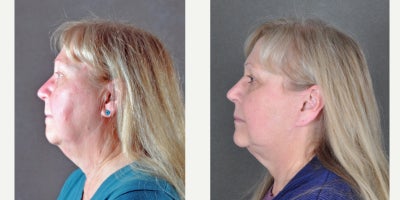 Eyelid Surgery before and after photo