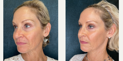 Halo Laser before and after photo