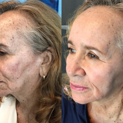 Laser Resurfacing before and after photo