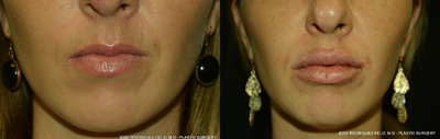 Lip Fillers before and after photo