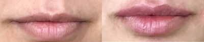Lip Fillers before and after photo