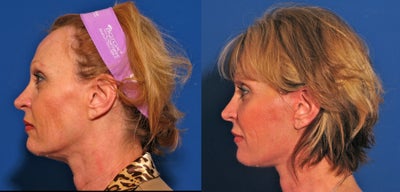 QuickLift before and after photo