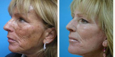 CO2 Laser before and after photo