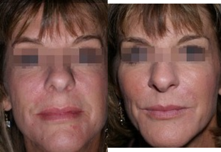 Radiesse before and after photo