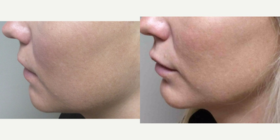Restylane Silk before and after photo