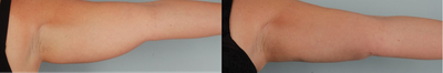 Arm Lift before and after photo