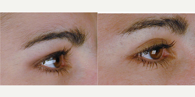 Brow Lift before and after photo