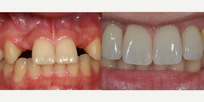Dental Implants before and after photo