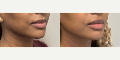 Lip Fillers before and after photo
