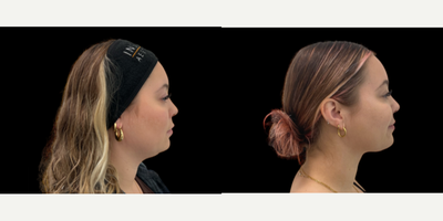 Liposuction before and after photo