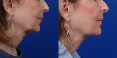 Ultherapy before and after photo