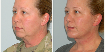 Chin Implant before and after photo