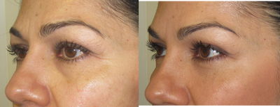 Juvederm before and after photo