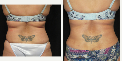 Liposuction before and after photo