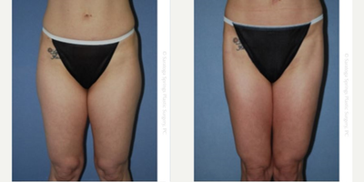 Liposuction before and after photo