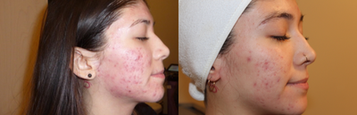 Microneedling RF before and after photo