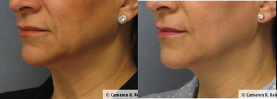 ThermiTight before and after photo