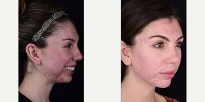 Microneedling RF before and after photo