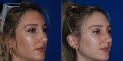 Revision Rhinoplasty before and after photo