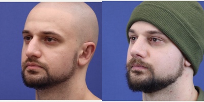 Rhinoplasty before and after photo