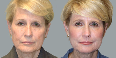 CO2 Laser before and after photo