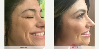 Dermal Fillers before and after photo