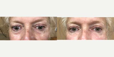 Dermal Fillers before and after photo