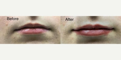 Dermal Fillers before and after photo