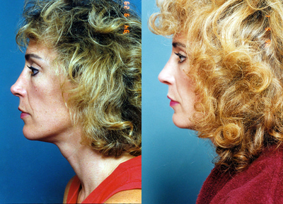 Revision Rhinoplasty before and after photo