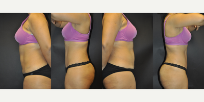 Tummy Tuck before and after photo