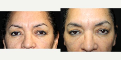 Botox before and after photo