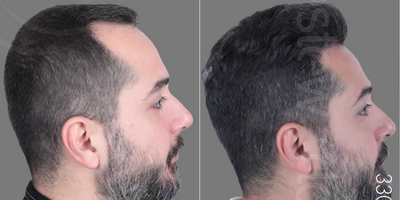 Hair Transplant before and after photo