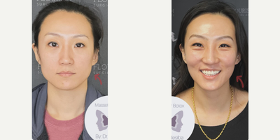 Botox before and after photo