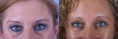 Brow Lift before and after photo