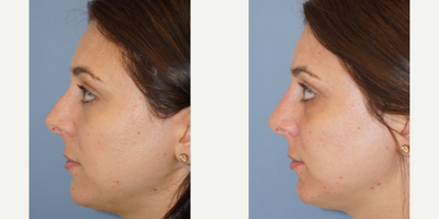 Nonsurgical Nose Job before and after photo