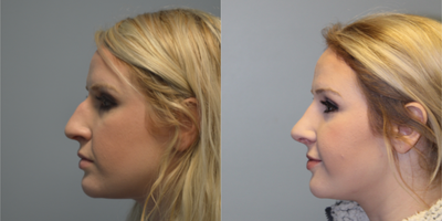 Rhinoplasty before and after photo
