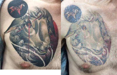 Tattoo Removal before and after photo