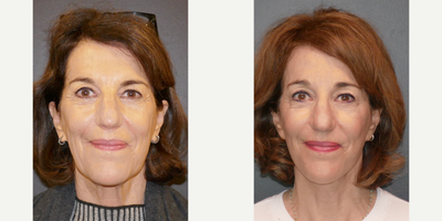 Deep Plane Facelift before and after photo