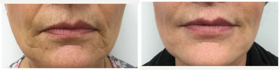 Dermal Fillers before and after photo