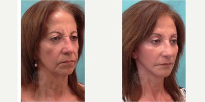 Facelift before and after photo