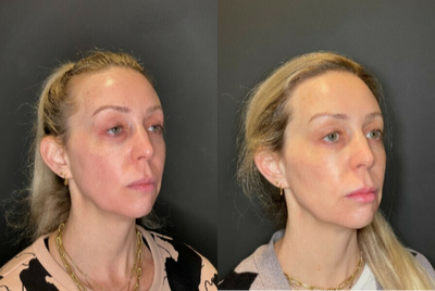 Halo Laser before and after photo