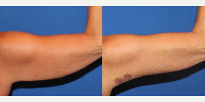 Arm Lift before and after photo