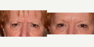 Botox before and after photo