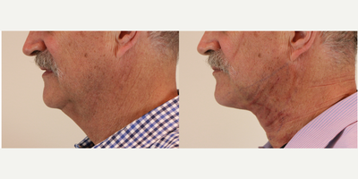 FaceTite before and after photo